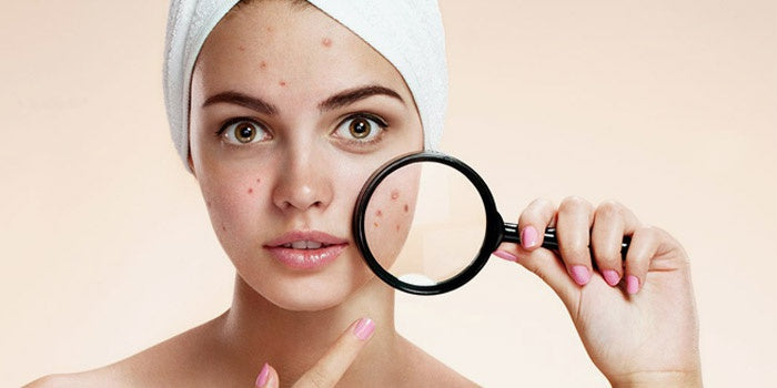 Cicatrici  acneiche: come eliminarle